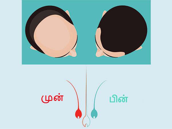 Put a Few Drops of This Syrup on Your Scalp and Wait to See All Your Lost Hair Grow Back… Awesome!