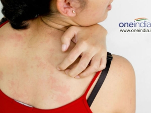 How To Get Rid Of Prickly Heat With Home Remedies