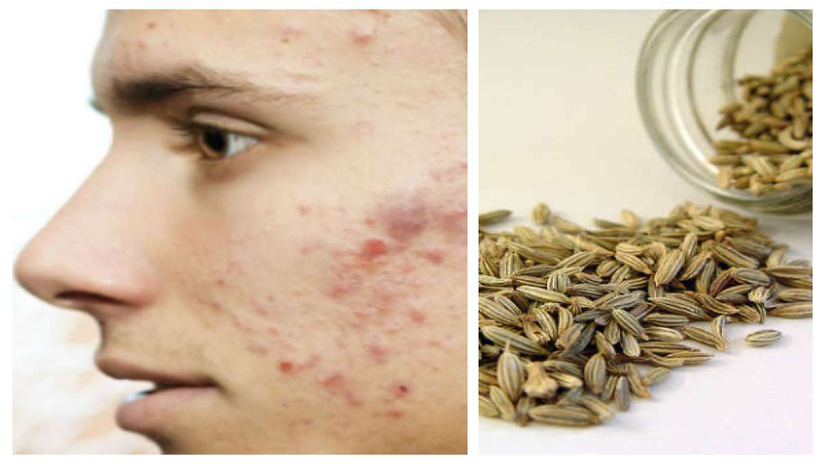 முகப்பருக்களை விரட்ட, பெருஞ்சீரகத்தை இந்த பொருளோடு சேர்த்து முகத்துல