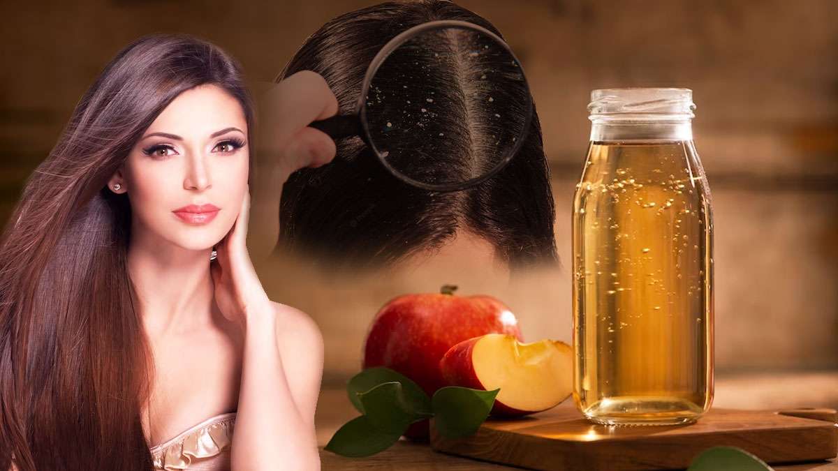 உங்க தலையில பொடுகு அதிகமா இருக்கா? அப்ப ஆப்பிள் சீடர் வினிகரை இந்த