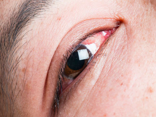 விழி வெண்படல அழற்சி (Conjunctivitis)