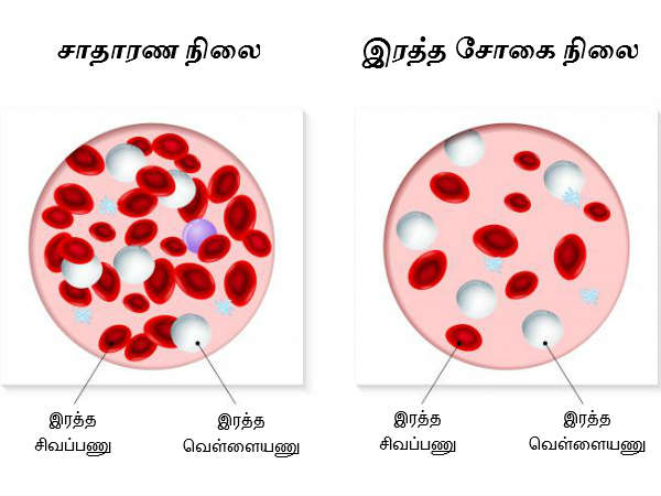 இரத்த சோகை