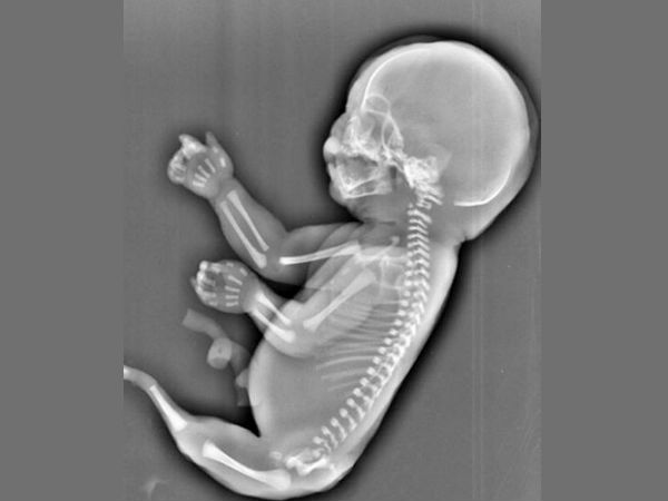 கடற்கன்னி உருவில் வளர்ந்த சிசு ...