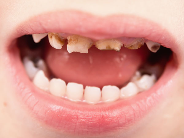 6.பாட்டில் பால் தீமைகள்