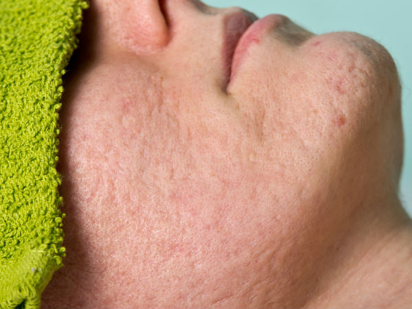 Natural DIY 2-ingredient Face Packs To Shrink Open Pores