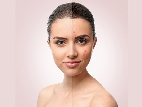 Here's How You Can Use Rice Water For Acne Reduction