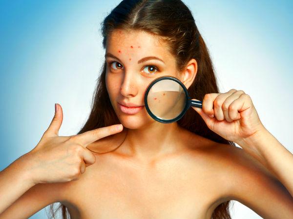 பருக்களுக்கு தீர்வு (ACNES)