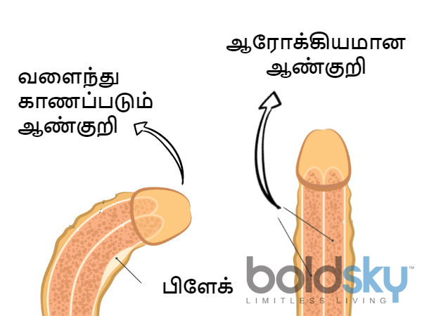 பெயரோய்ன் நோய்