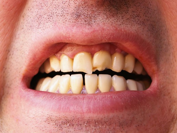 உடைந்த பல் - ஞாபகக் கோளாறு