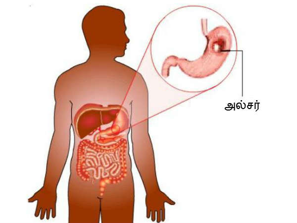 வயிற்று புண்