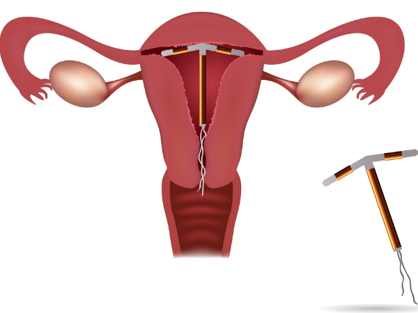 தவறாக வைக்கப்பட்ட IUD
