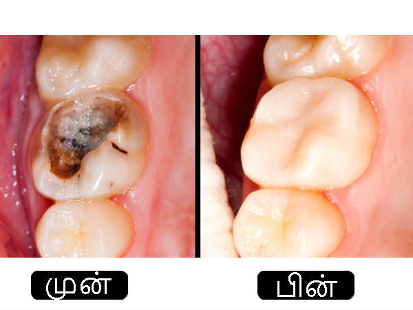 பல் அழுகல்