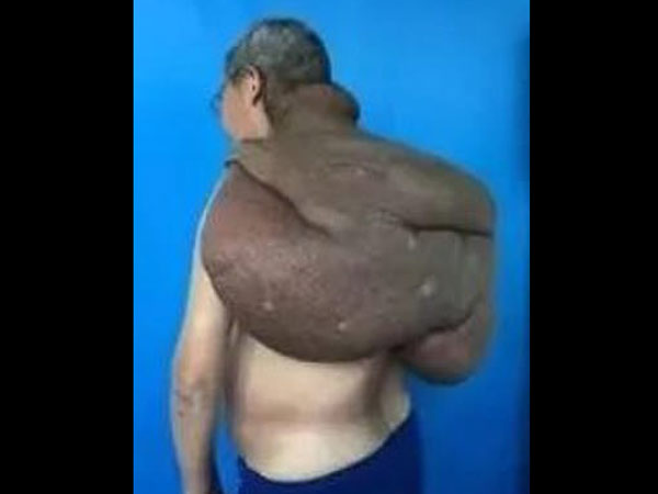 30 வருடங்களாக வளர்ந்த கட்டி