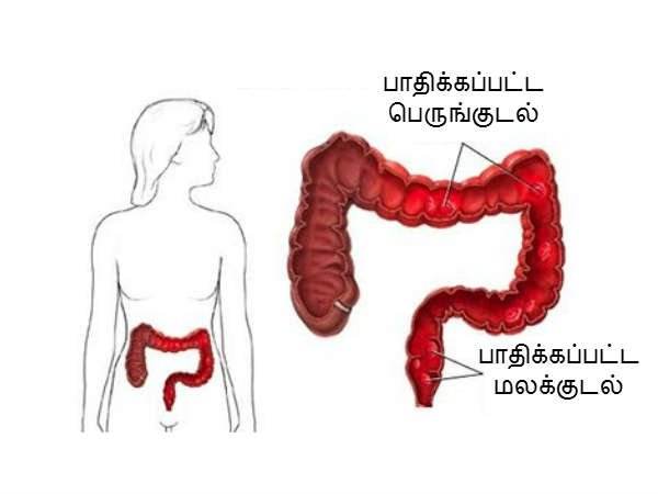 மலக்குடல் என்றால் என்ன?