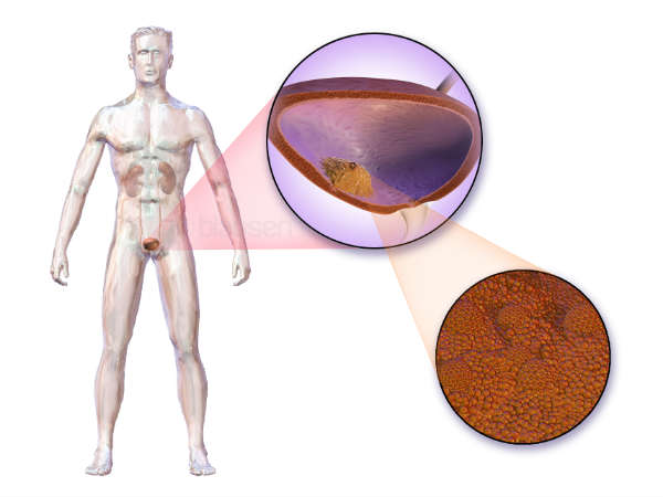 How To Prevent Bladder Infections