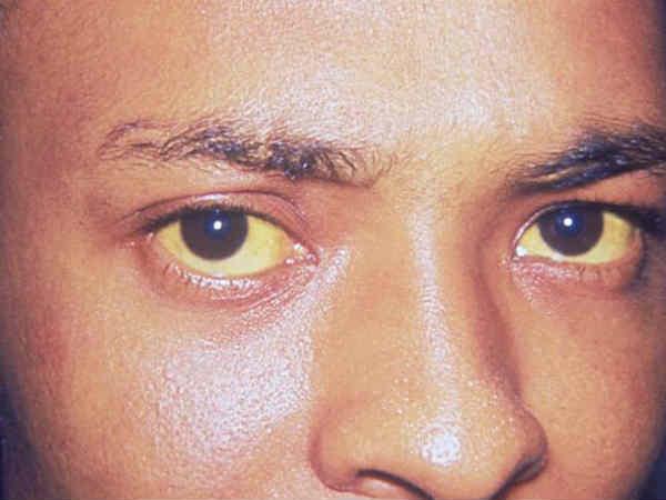 இறுதி கட்ட கல்லீரல் நோயின் அறிகுறிகள்: