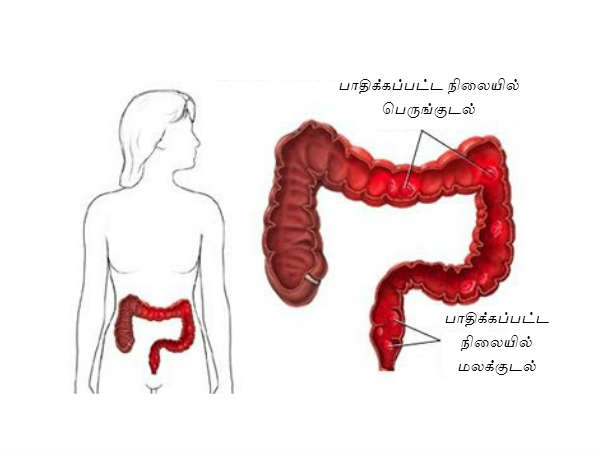 பெருங்குடல் புண்