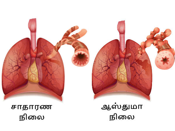 ஆஸ்துமா
