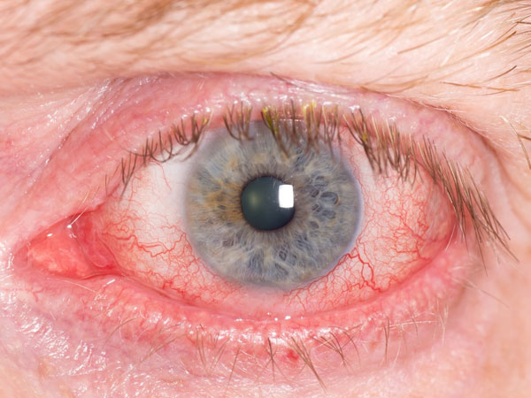 ஹைஃபெமா (Hyphema)