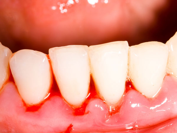 ஈறுகளில் இரத்தக்கசிவு