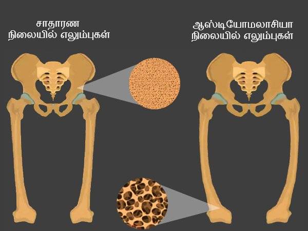எலும்பு மெலிவு நோய் (Osteomalacia)