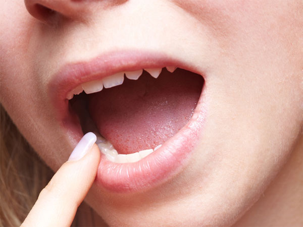 ஓரல் சப்ம்யூக்கஸ் ஃபைப்ரோஸிஸ் (Oral Submucous Fibrosis)