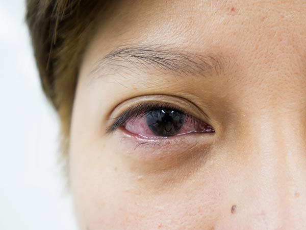 கருவிழிப்படல அலா்ஜி (Uveitis)