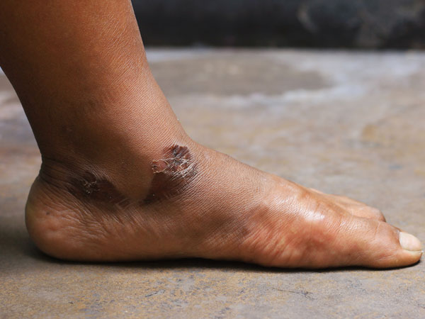 காயங்கள் குணமாகாமல் இருப்பது