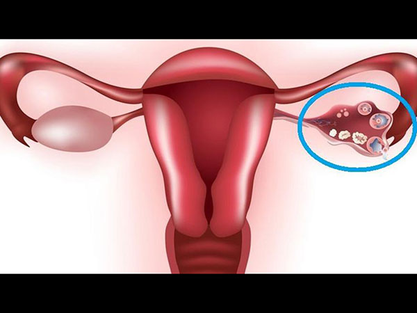 பெண்களின் வயதுக்கு ஏற்ப முட்டைகளின் சராசாி எண்ணிக்கை