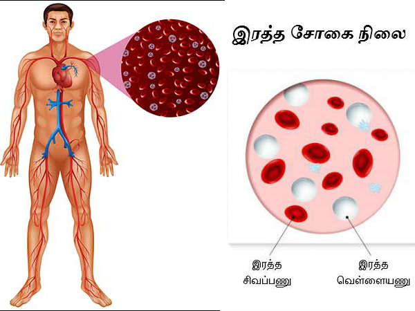 இரத்த சோகை