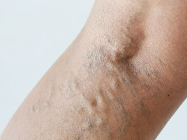 போதுமான சிரை அல்லது இரத்த நாளங்கள் (Venous) இல்லாமை