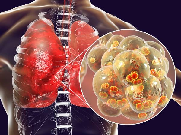 உயிருக்கு ஆபத்தை ஏற்படுத்தும் மஞ்சள் பூஞ்சை யாருக்கெல்லாம் வரும்? அதன் அறிகுறிகள் என்னென்ன தெரியுமா?