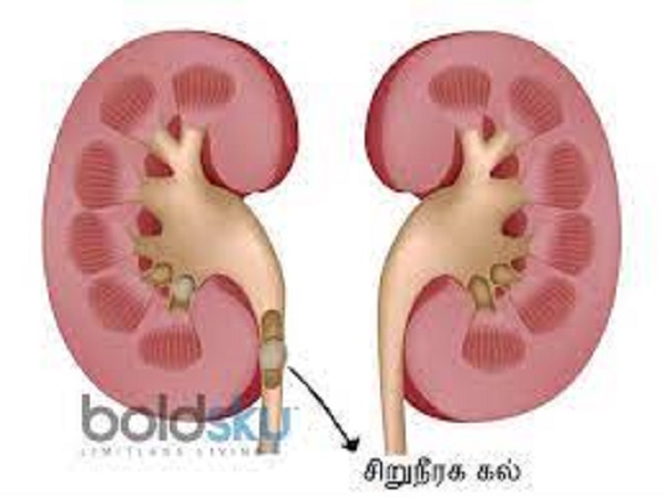 சிறுநீரக கற்கள்
