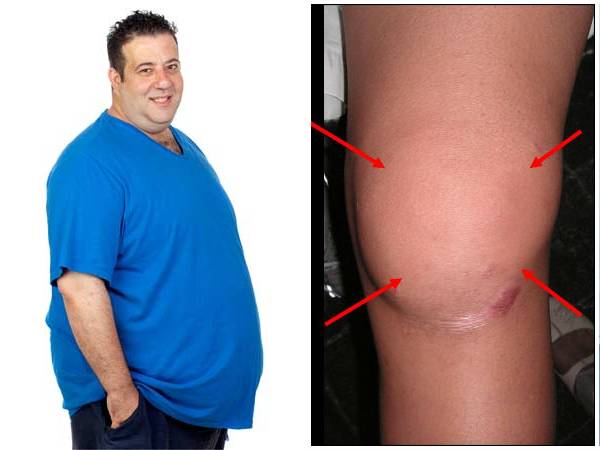 உடல் பருமன் மற்றும் மூட்டு வீக்கத்தால் கஷ்டப்படுறீங்களா? அப்ப இந்த 3 மூச்சுப் பயிற்சிகளைச் செய்யுங்க...