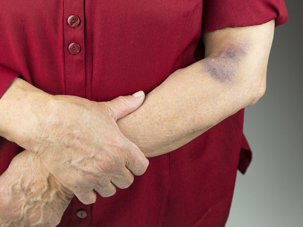 அடிக்கடி காயம் ஏற்படுதா? இல்ல எந்த அடியும் படமா காயம் ஏற்படுதா? அப்ப இது காரணமா இருக்கலாமாம்!