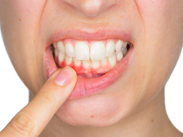 ஈறுகளில் இரத்தக்கசிவு