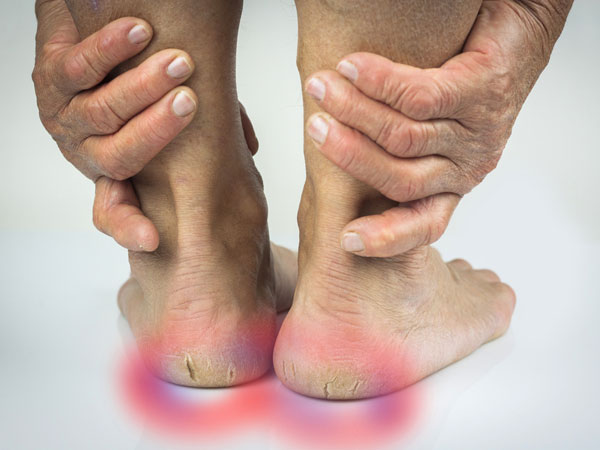 உங்க குதிகாலில் 'இந்த' மாதிரி வெடிப்புகள் இருந்தா அது ஆபத்தான பிரச்சனையின் அறிகுறியாம்... ஜாக்கிரதை!