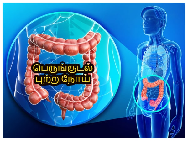 இந்த உணவுகள் குடல் புற்றுநோய் வராமல் தடுப்பதோடு புற்றுநோய் செல்களை எதிர்த்து போராடுமாம் தெரியுமா?