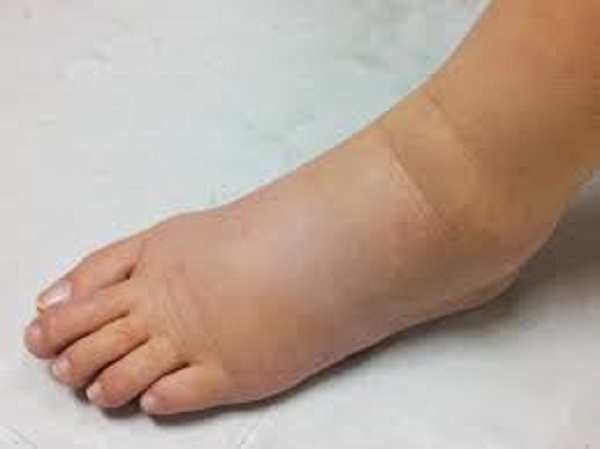 கைகள் மற்றும் கால்களில் அசாதாரண வீக்கம் அல்லது உணர்வின்மை