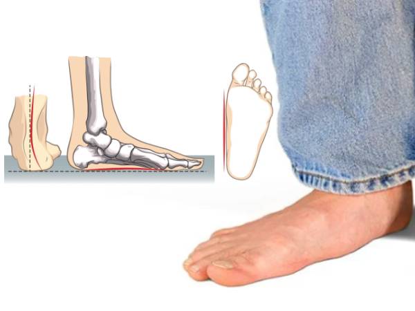 உங்க பாதம் இப்படி தட்டையா இருக்கா? அது எதனால் ஏற்படுகிறது தெரியுமா?