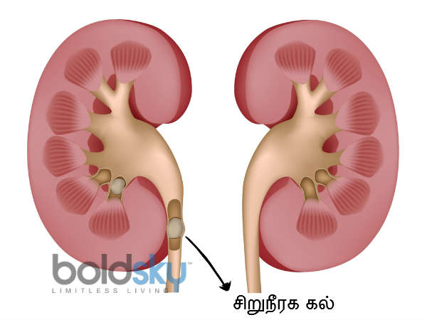 சிறுநீரகத்தில் கற்கள் இருந்தால் வெளிப்படும் ஆரம்ப கால எச்சரிக்கை அறிகுறிகள்!