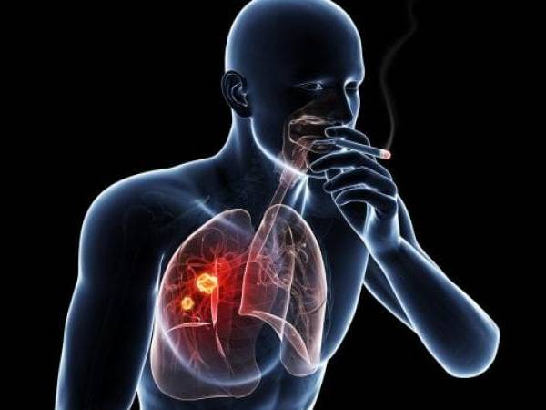 புகைப்பிடிக்கும் சிலருக்கு மட்டும் ஏன் நுரையீரல் புற்றுநோய் வருகிறது? மற்றவா்களுக்கு ஏன் வருவதில்லை?