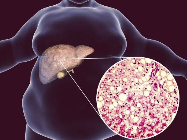 காலையில் இந்த மாதிரி உங்களுக்கு உணர்வு இருந்தா... அது ஆபத்தான கல்லீரல் நோயோட அறிகுறியாம்...!