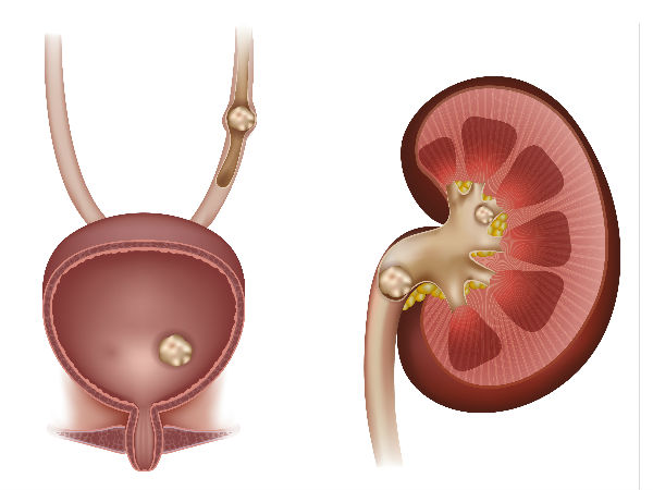 உங்க கிட்னியில் கற்கள் உருவாக இருக்கணுமா? அப்ப இந்த உணவுகளை தெரியாமகூட தொட்றாதீங்க...!