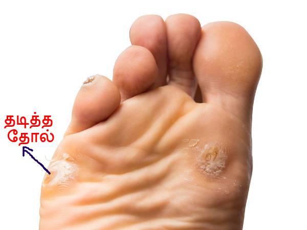 கார்ன் அல்லது கால்சஸ்