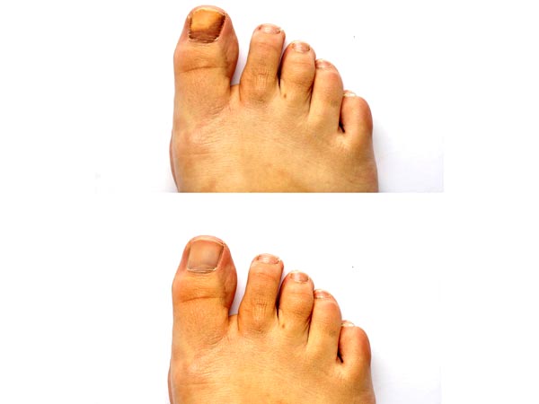 நகங்களில் பூஞ்சைத் தொற்று