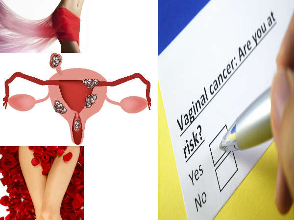 இந்த அறிகுறிகள் இருந்தால் உங்க பிறப்புறுப்பில் புற்றுநோய் இருக்குமாம் ...அலட்சியமா இருக்காதீங்க!