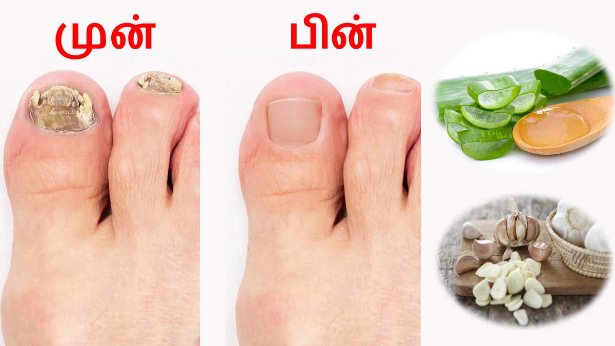 உங்க கால்விரல் நகங்கள் 'இப்படி' அசிங்கமா இருக்கா? இதோ அதை போக்கும் சில