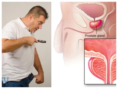 prostate cancer meaning in tamil